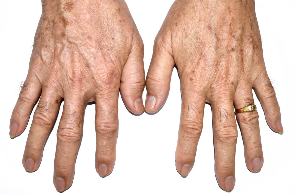 What Can I Do About Brown Aging Spots On My Hands 